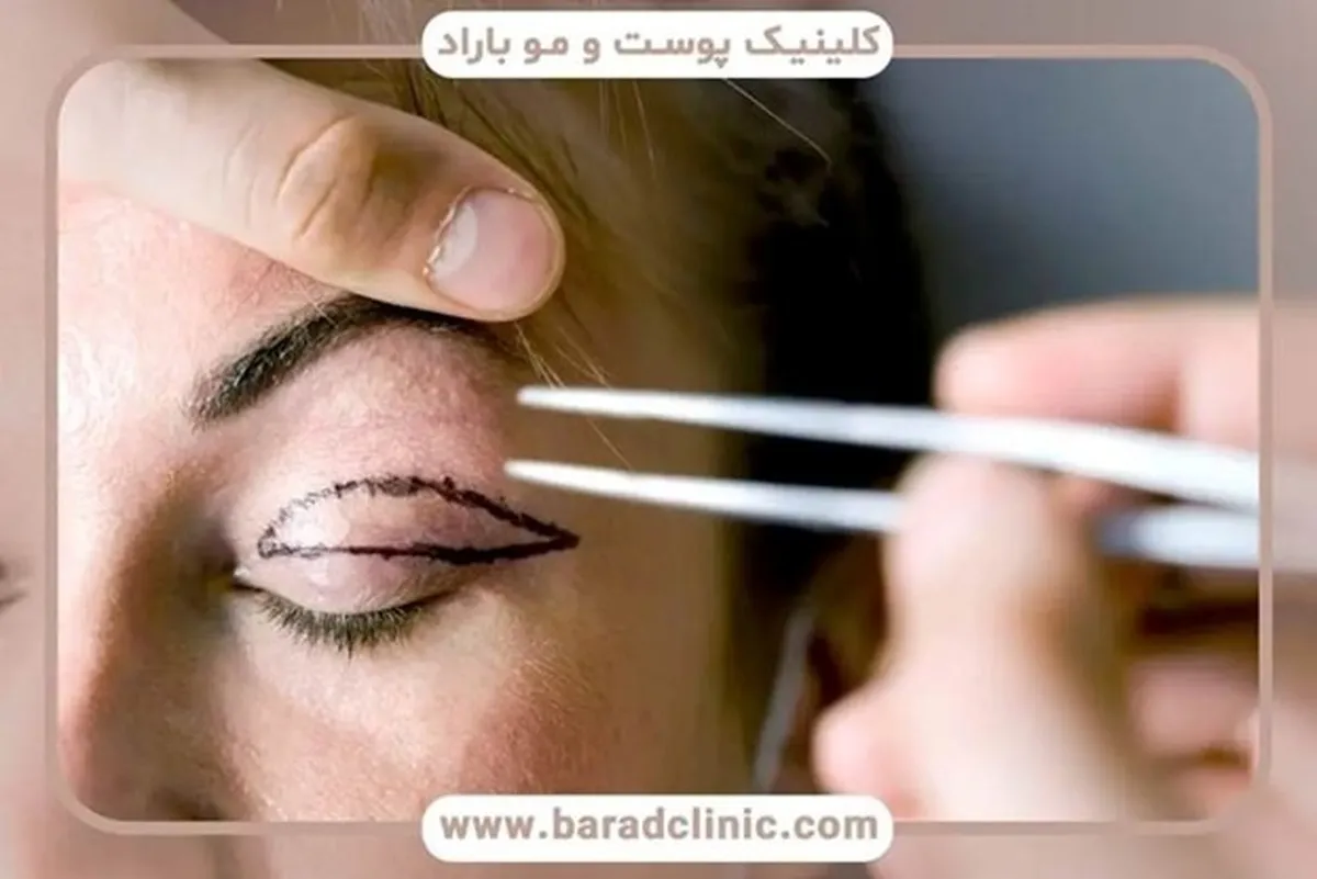 بهترین دکتر بلفاروپلاستی را چگونه انتخاب کنیم؟